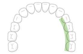 臼歯(舌側)