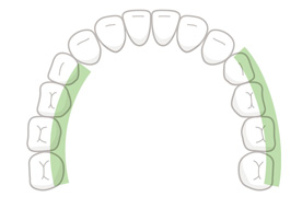 臼歯(舌・頬側)