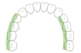 臼歯(舌・頬側)