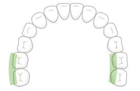 大臼歯(舌・頬側)
