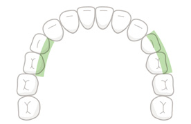 小臼歯(舌・頬側)