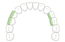 小臼歯(舌・頬側)
