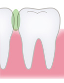 歯間部