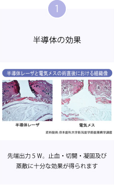1 半導体の効果 先端出力５Ｗ。止血・切開・凝固及び蒸散に十分な効果が得られます