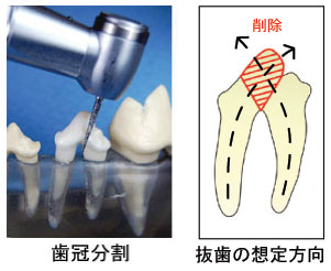 抜歯の想定方向