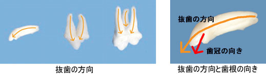 抜歯の方向・歯根の向き